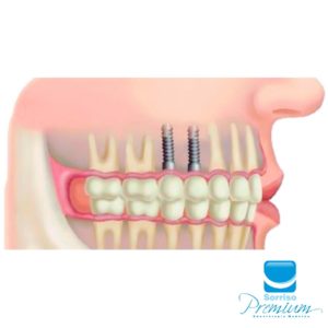 Implante Dentário - Sorriso Premium