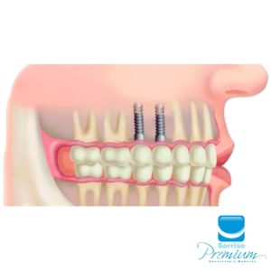 Implante Dentário - Sorriso Premium