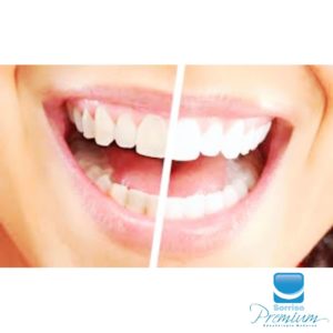 Clareamento - Sorriso Premium